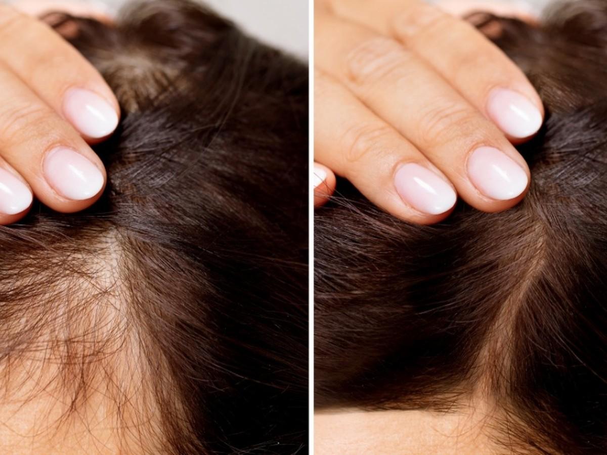 alopecia areata 10 rimedi naturali per contrastarla
