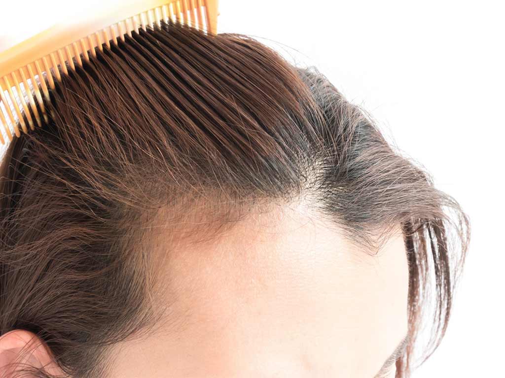 5 rimedi naturali per contrastare il diradamento dei capelli